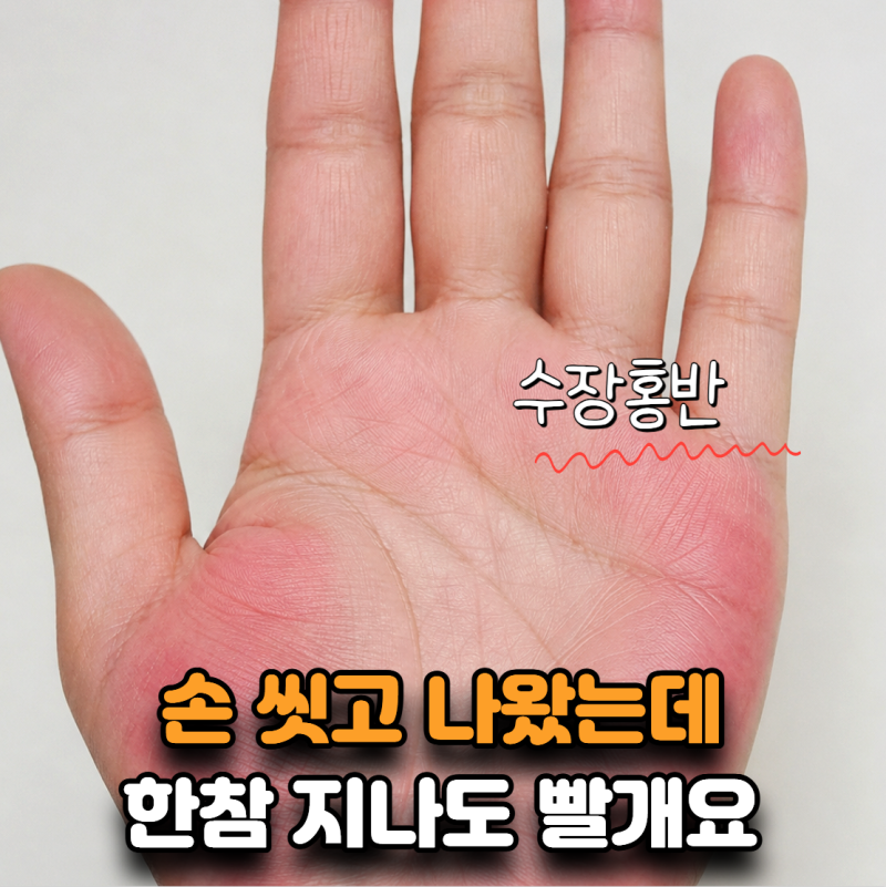 “손 씻고 나왔는데 한참 지나도 빨개요” 수장홍반, 간 때문일까?