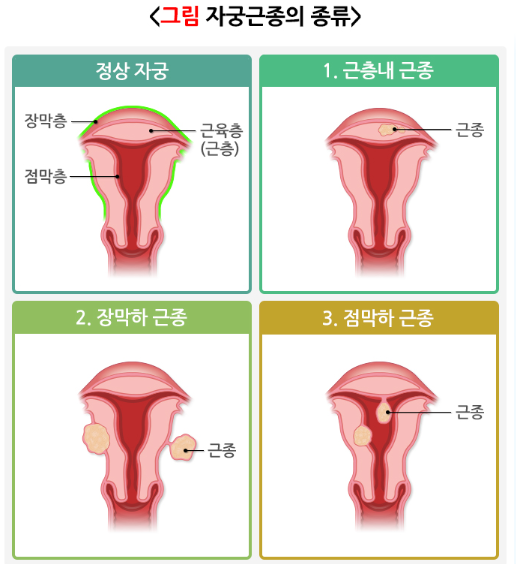 [시화병원 메디프렌즈 서포터즈 1기 활동] 건강검진에서 자궁에 혹이 있다고요? 자궁근종은 ....