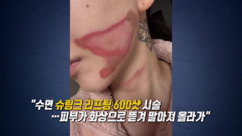 “수면 슈링크 600샷 후 얼굴 화상”…권민아 심재성 2도 화상부터 병원과 소송까지