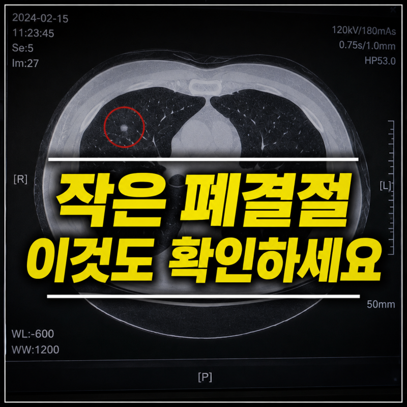 폐결절 4mm 작아서 괜찮은 줄 알았습니다, 흉부CT에서 모양까지 확인하는 이유