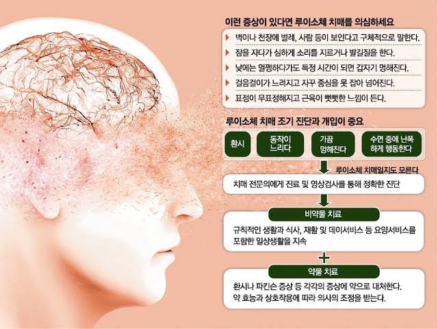 치매 초기증상,치료제, 전조증상, 검사, 예방약, 원인에 대해서 알아보자
