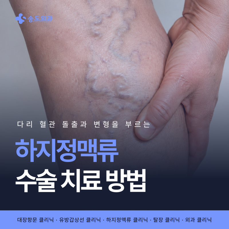 인천 송도 하지정맥류 베나실 포함 치료법 총정리, 베나실 안전할까?