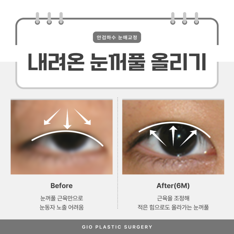 안검하수 눈매교정 하기전 자가진단 해보니