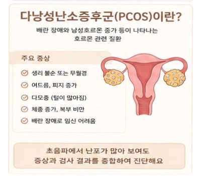 다낭성난소증후군 생리불순 임신준비