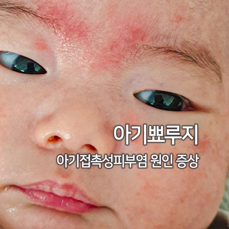 아기뾰루지 아기접촉성피부염 원인 증상, 집에서 하는 관리법
