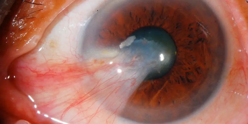 포도막염 Uveitis : 눈 속에서 시작된 작은 불꽃을 인류는 3,700년 동안 어떻게 껐을까요?