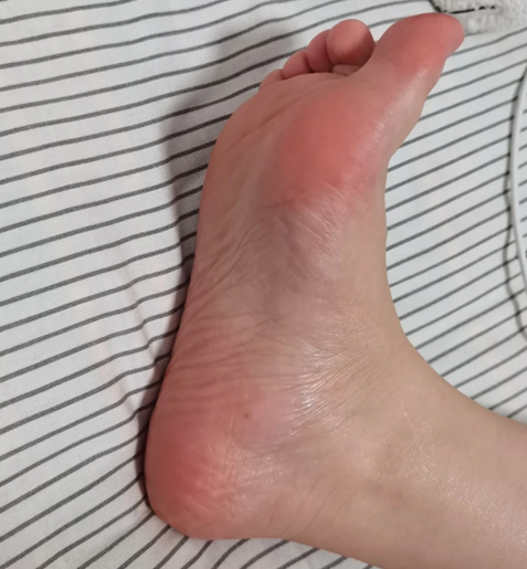오른쪽엄지발가락통증 찌릿하고 시릴 때 의심해볼 질환