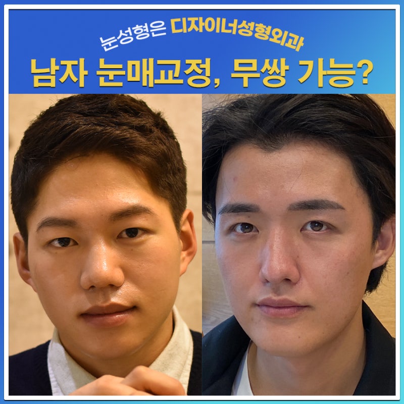 남자눈매교정, 무쌍으로 가능할까요? 남자쌍수와 무쌍눈매교정술의 차이