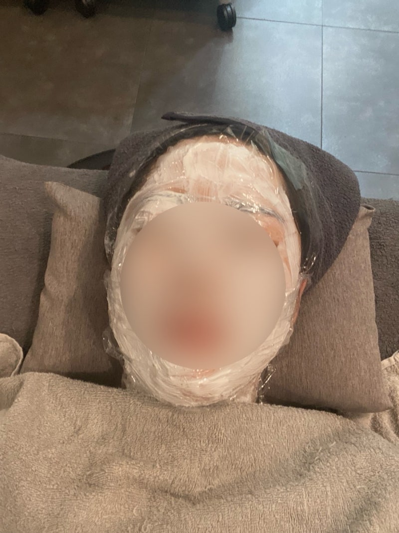 편평사마귀, 쥐젖, 비립종 153개 제거 후기 [라르떼의원]