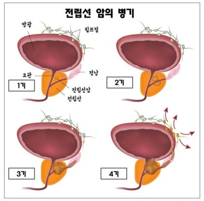 전립선암 3기 치료 과정을 남겨 놓는다.