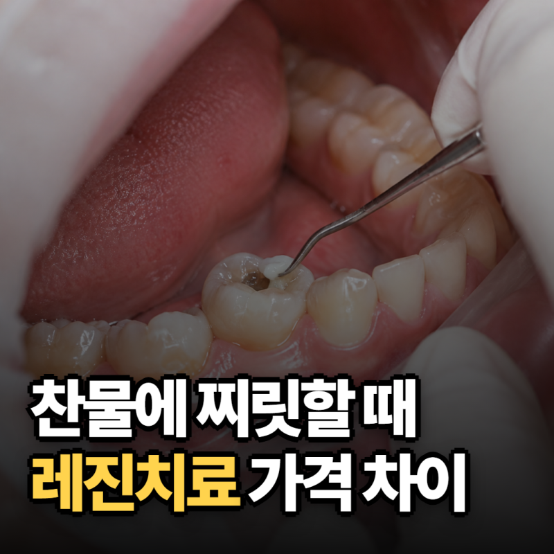 "찬물에 찌릿한 어금니" 치아레진 가격, 치과마다 2배 다른 이유