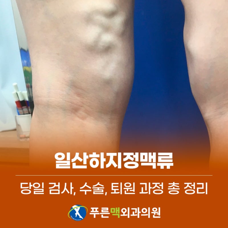 일산하지정맥류 당일 검사, 수술, 퇴원 과정 총 정리