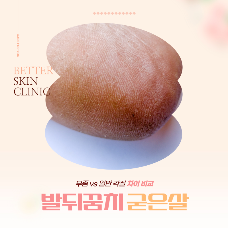 발뒤꿈치 굳은살 무좀 vs 일반 각질 차이 비교