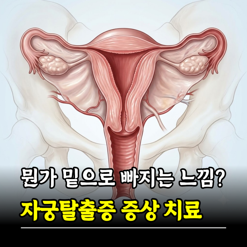 뭔가 밑으로 빠지는 느낌? 자궁탈출증 증상 원인 치료 수술