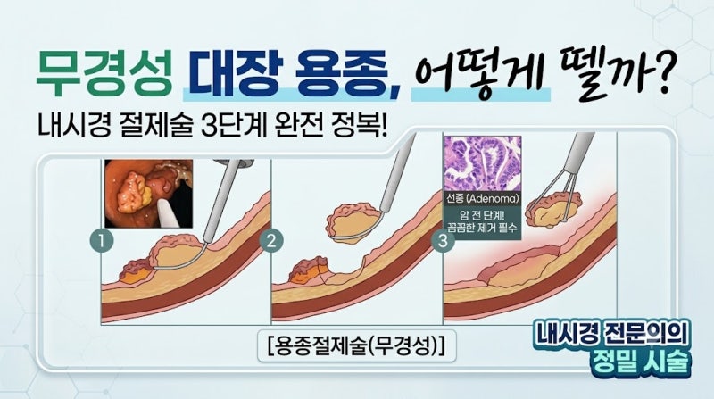 대장내시경 용종의 종류와 관리