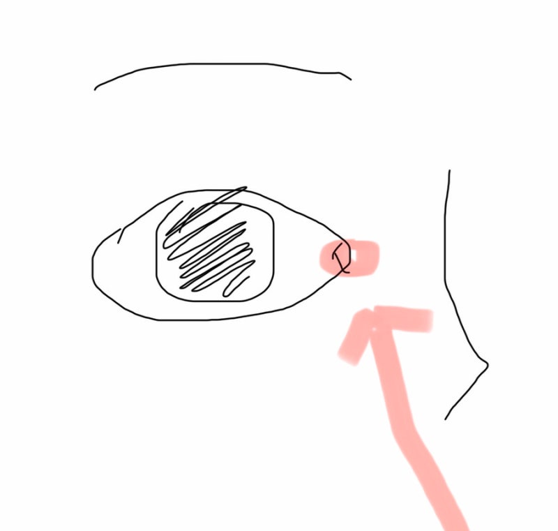 신생아때부터 6개월까지 눈물눈곱 계속 꼈던 아기 - 엄마가 직접 눈물샘 뚫은 후기!! (눈물샘 ....