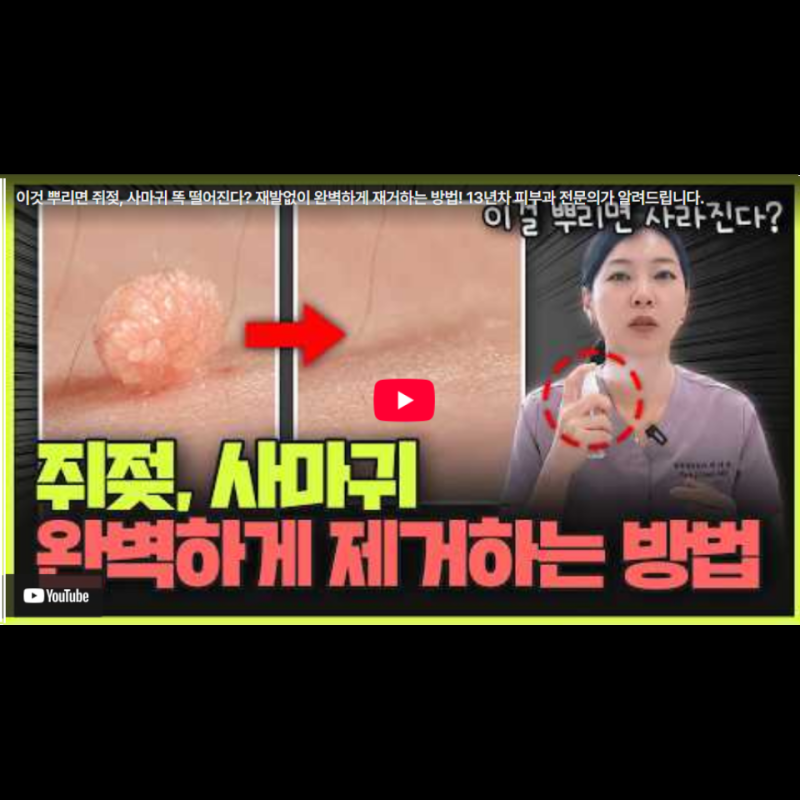 잠원동 피부과 쥐젖, 편평사마귀 없애는 법 전문의가 알려드려요