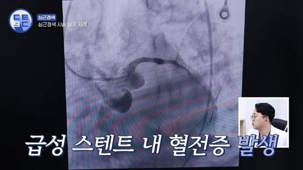 안산 심근경색 시술 후 왜 중환자실에 있어야 할까? 스텐트 시술과 합병증 총정리