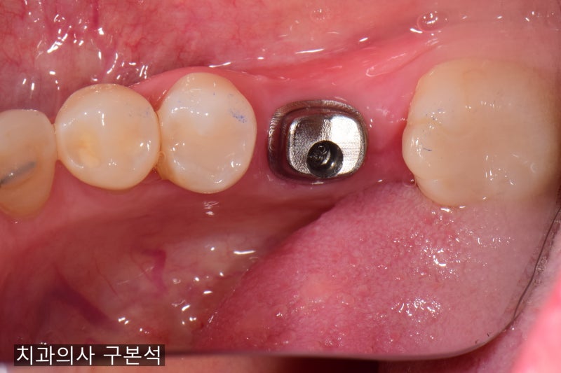 어금니 임플란트 가격 및 과정-치조골이식수술 유무