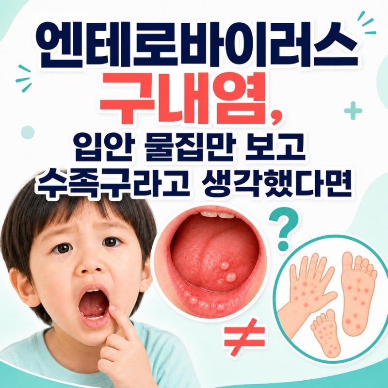 엔테로바이러스 구내염, 입안 물집만 보고 수족구라고 생각했다면