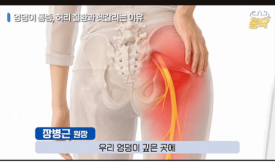 서초 이상근증후군, 허리 치료 후에도 엉덩이가 찌릿하고 다리가 저린다면?