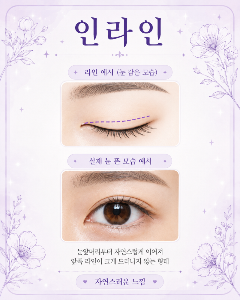쌍꺼풀수술 라인 종류 정리해 드릴게요!