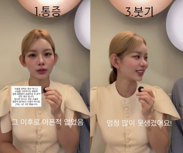 [성형] 맹승지 인중축소 수술 비 600만원···통증·부기 어땠나? 남자친구 직업까지