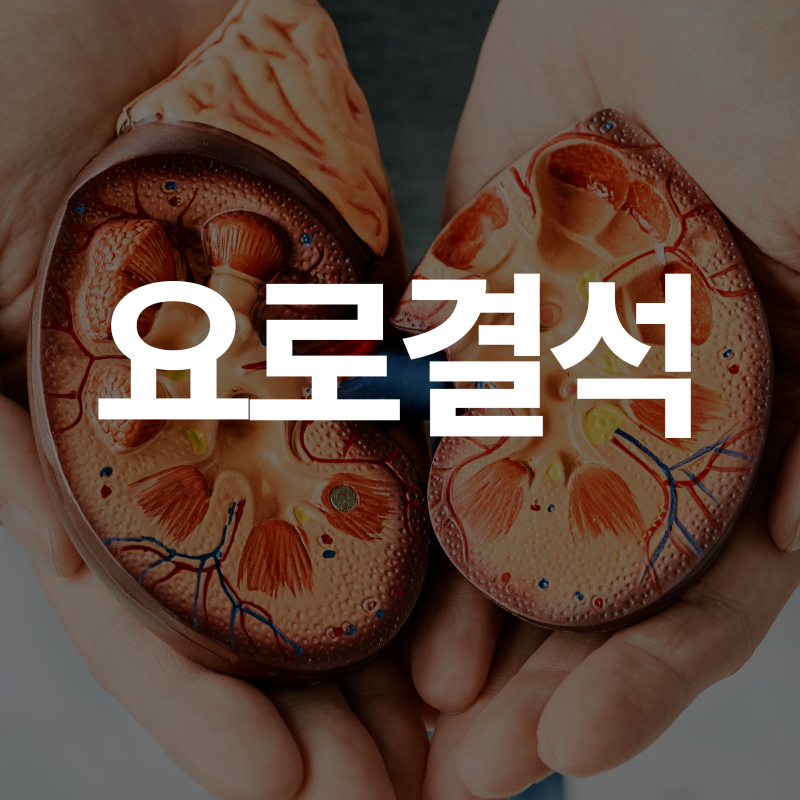 요로결석 완전 정리 원인부터 쇄석술 로봇수술까지