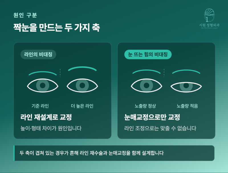 쌍꺼풀 수술 후 남은 짝눈, 라인 재수술과 눈매교정의 감별 진단