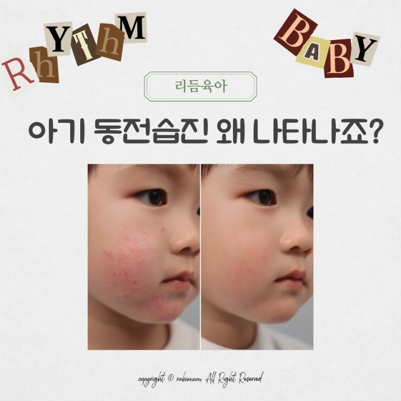 아기 동전습진 원인과 증상, 집에서 돌보는 방법