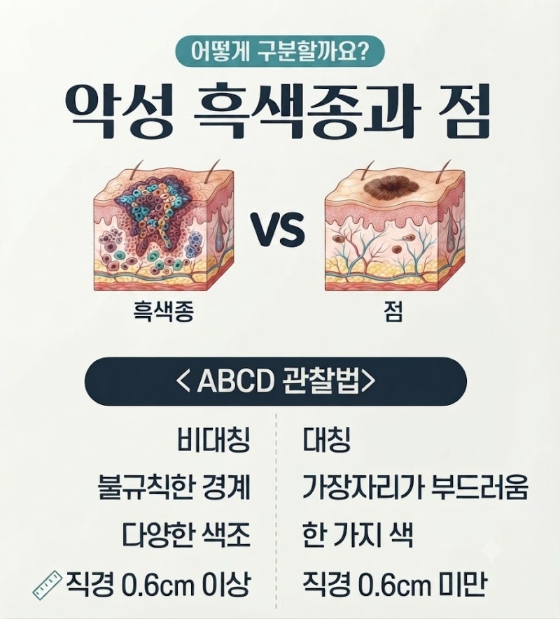 발바닥 점 흑색종일 수도 있다는 사실 알고 계셨나요?