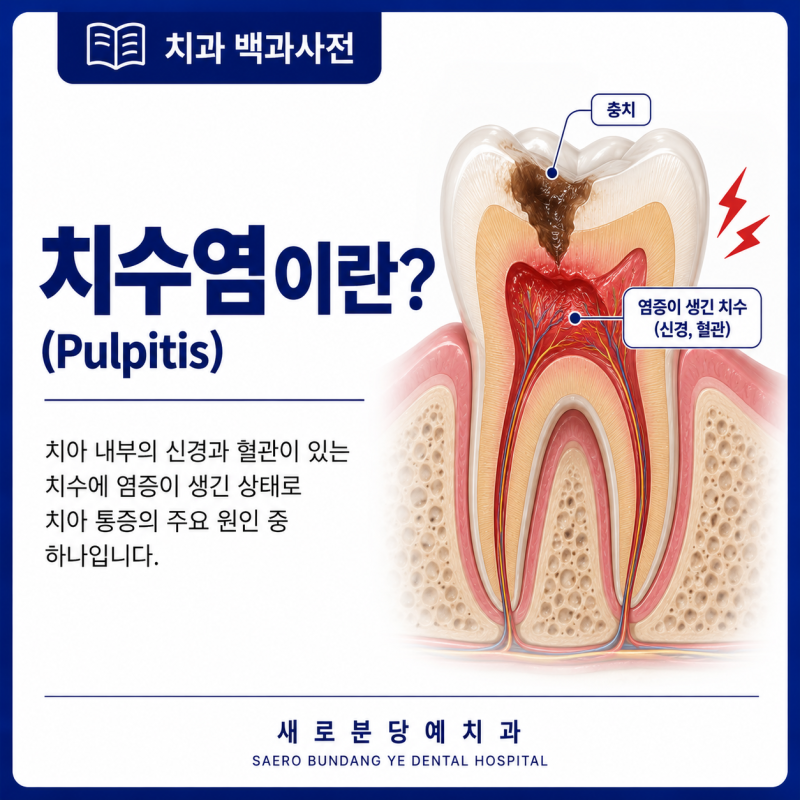 치수염(Pulpitis)이란?