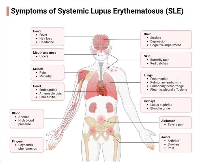 '1,000가지 얼굴을 가진 병' 루푸스(Systemic Lupus Erythematosus; SLE), 2030 가임기 여성에서 증가하는 ....