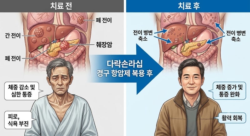 췌장암 2차 치료의 새로운 선택지, '다락손라십'를 소개합니다