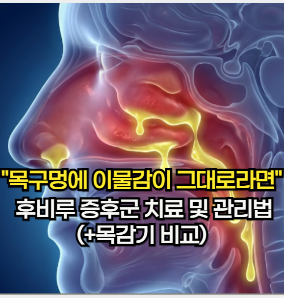 후비루 증상 "약 먹어도 목구멍에 이물감이 그대로라면" 후비루 증후군 치료 및 관리법 (+목....