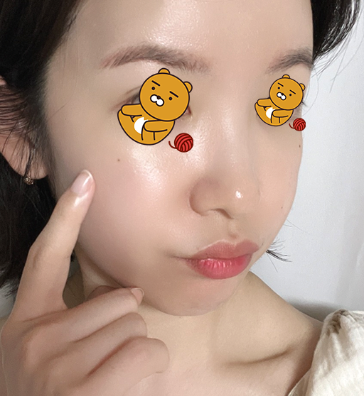 편평사마귀 제거 CO2 레이저 후기 (재발없는 관리팁)