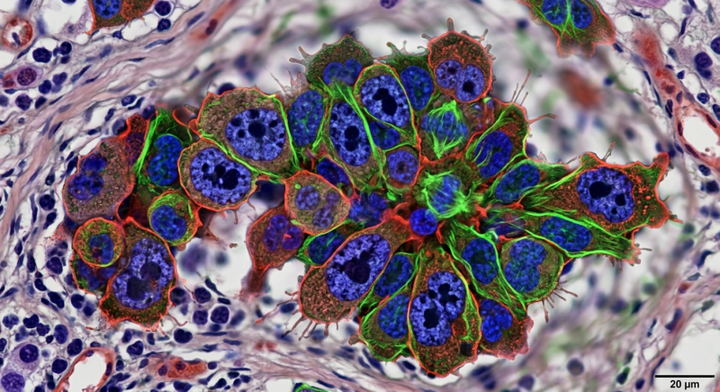 암 Cancer 발생 원인 종류 병기 1기 2기 3기 4기, 약물 수술 암 전문병원 암진단치료보장 보험 종....