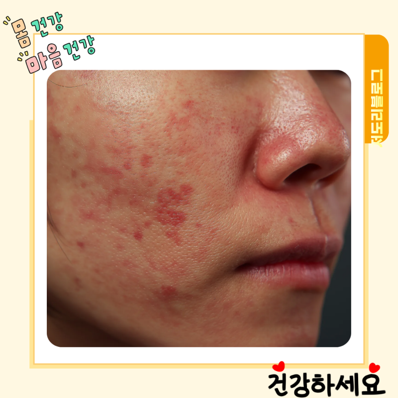 당뇨약 먹었더니 발진이 생기고 가렵다? 먼저 해야 할 일이 있습니다.