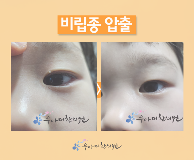 비립종 압출, 집에서 계속 짠 뒤 제거가 더 어려워지는 이유
