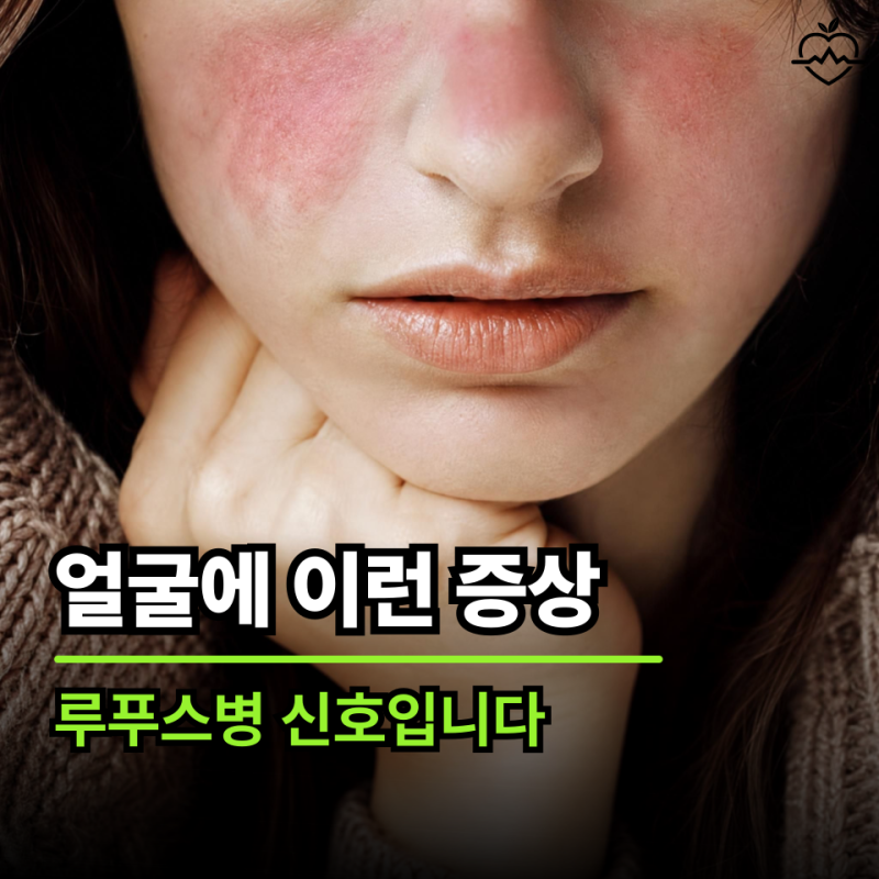 "얼굴에 이런 변화가 생겼다면 의심하세요" 루푸스병 초기증상과 자가면역질환의 위험 신호