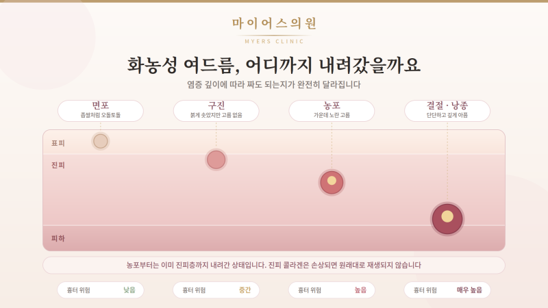 화농성 여드름 집에서 짜면 안 되는 진짜 이유 | 흉터 색소침착이 남는 과정과 올바른 대처법