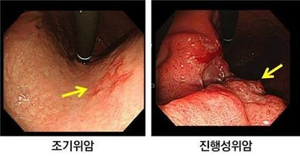 위암 발병원인과 증상 치료방법