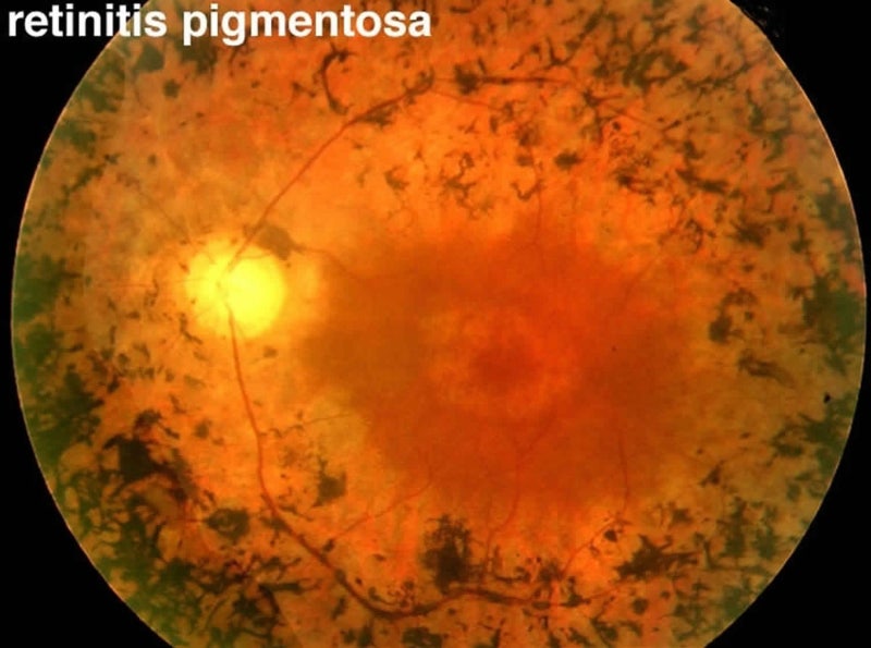 망막색소변성 Retinitis pigmentosa: 밤이 먼저 사라지는 병, 그러나 빛의 역사는 끝나지 않았습니....