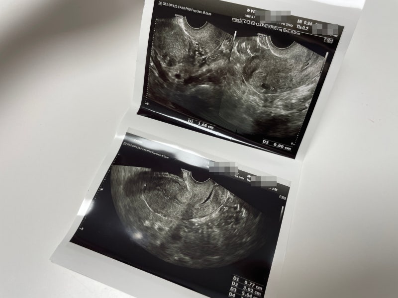 대전 신혼부부 산전검사 후기 2 (준비물, 검사 과정, 지원 금액, 검사비 청구 방법 등)