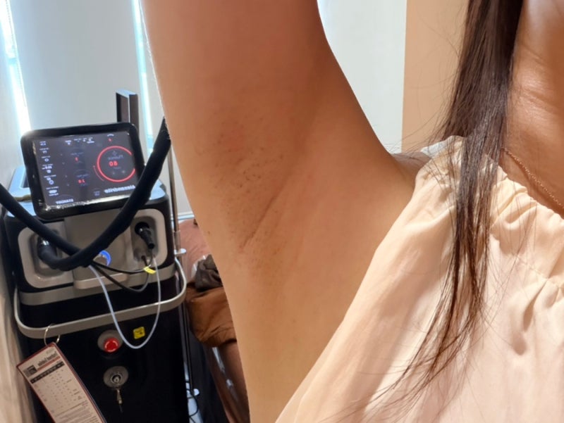 선릉역 피부과 겨드랑이 레이저제모 1회차 후기, 5년 만에 다시 시작한 이유