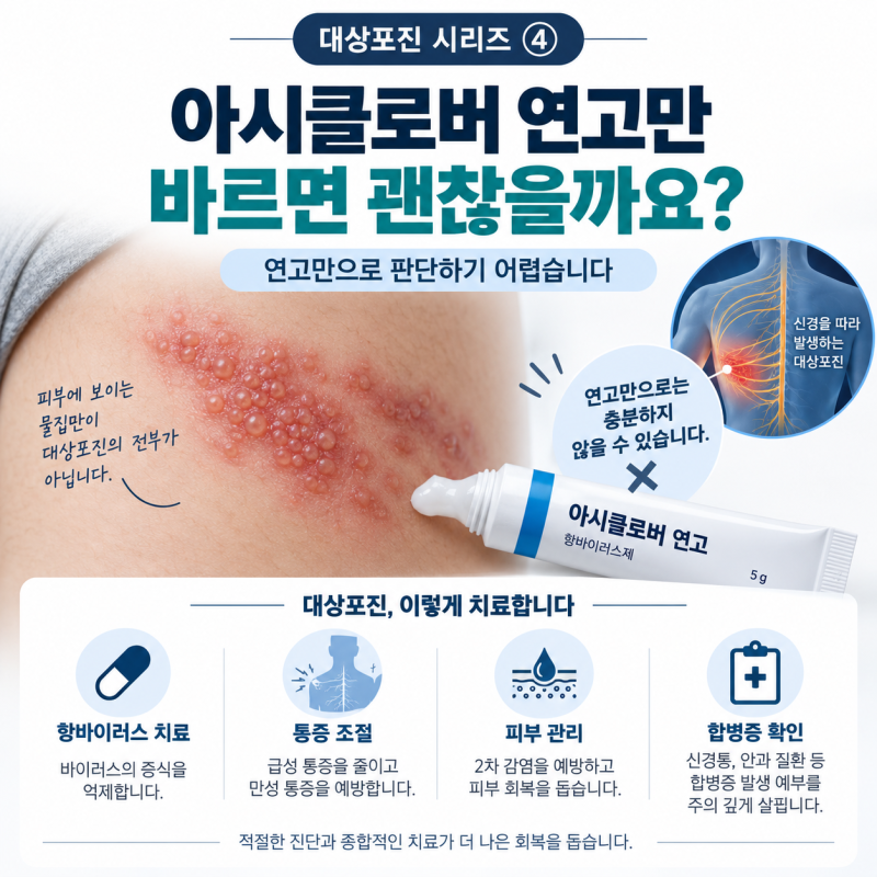 강동구 대상포진, 아시클로버 연고만 발라도 될까요? | 대상포진 시리즈 ④