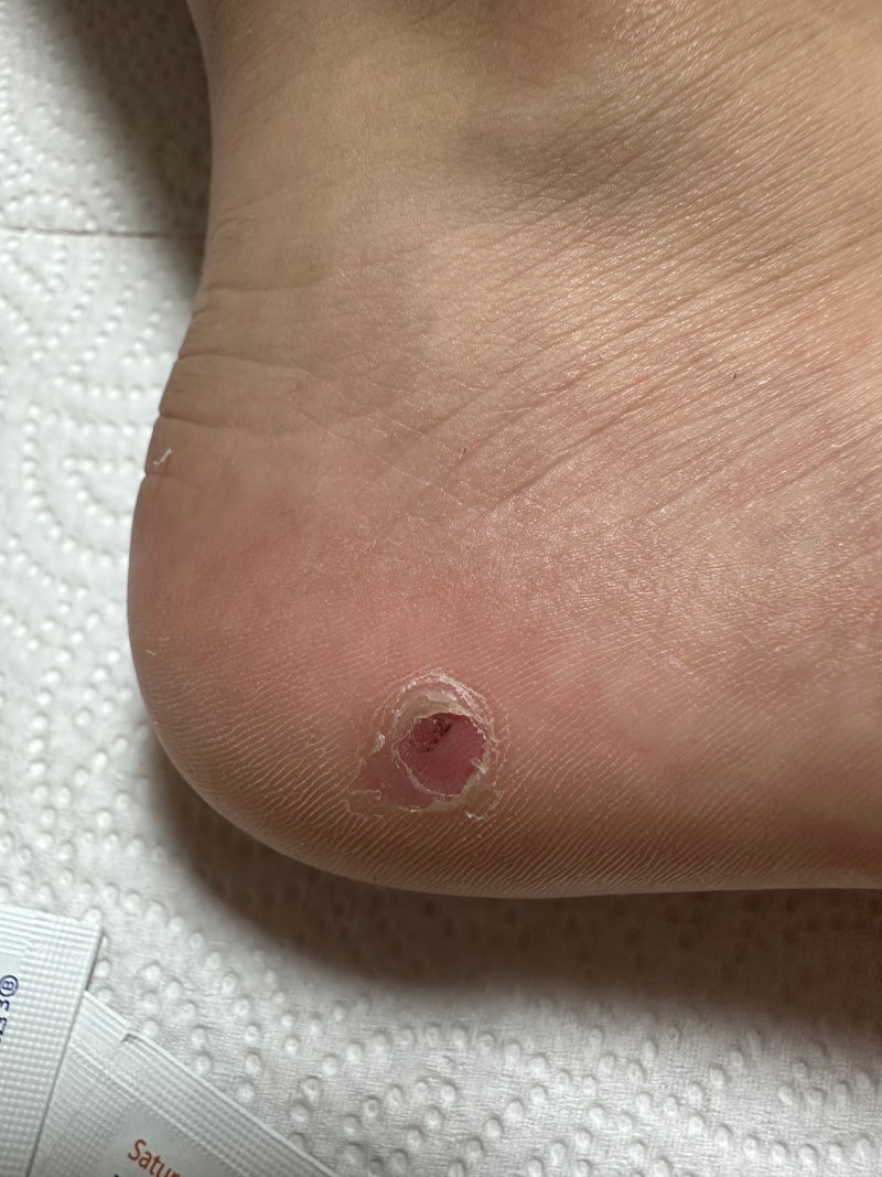 (간호사 엄마가 알려주는)발바닥 사마귀 6탄 사마귀 듀오케어 자가치료, 매일 달리지 마세요!....