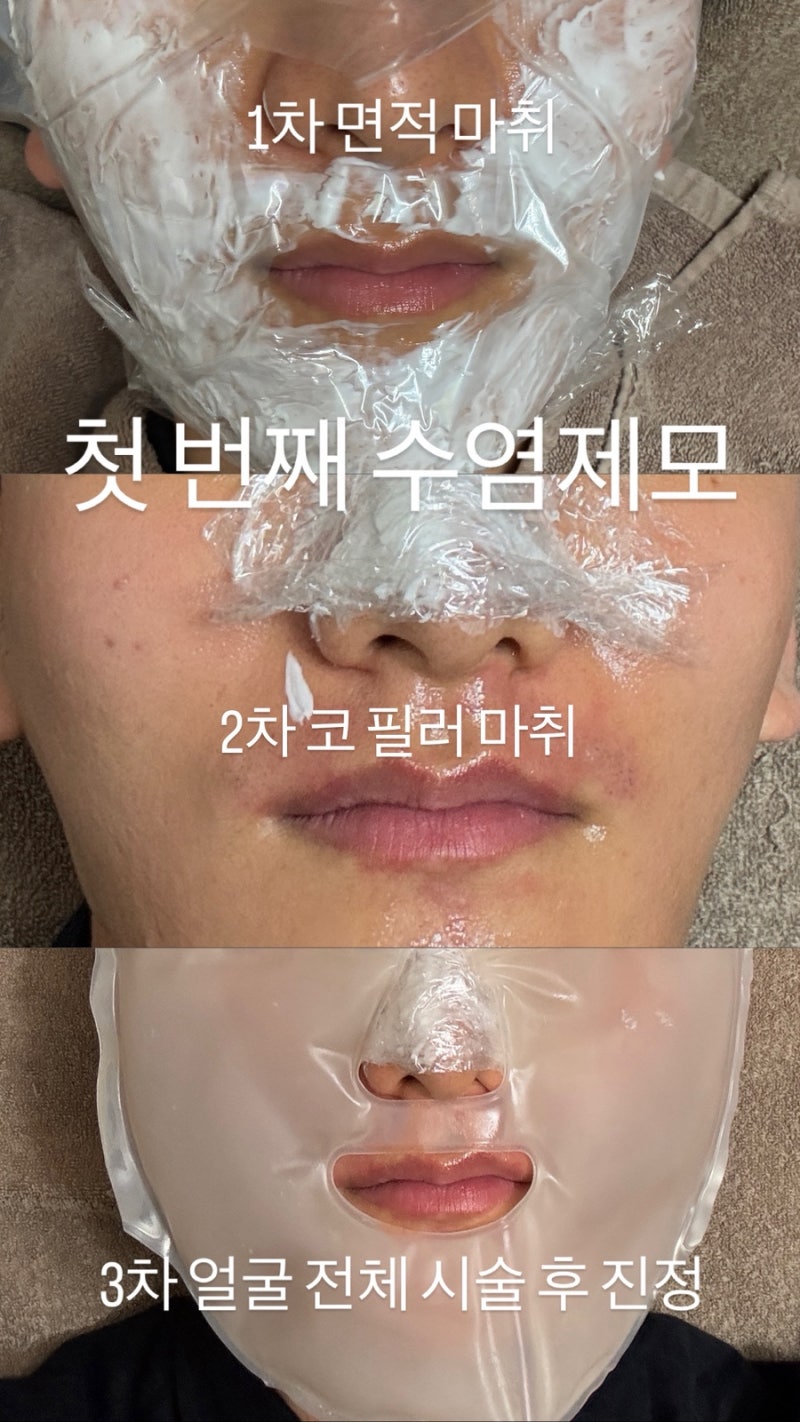강남 남자성형외과 후기 1탄｜맑고 고운 라벨라 성형외과 코필러·턱 보톡스·침샘 보톡스·....
