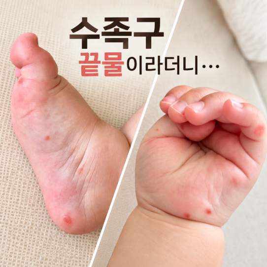 “수족구 끝물이라더니…” 10개월 아기 9월에 결국 걸렸어요