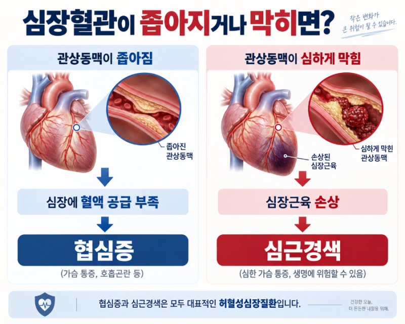 허혈성심장질환 진단비가 있으면 심근경색만 보장될까요?